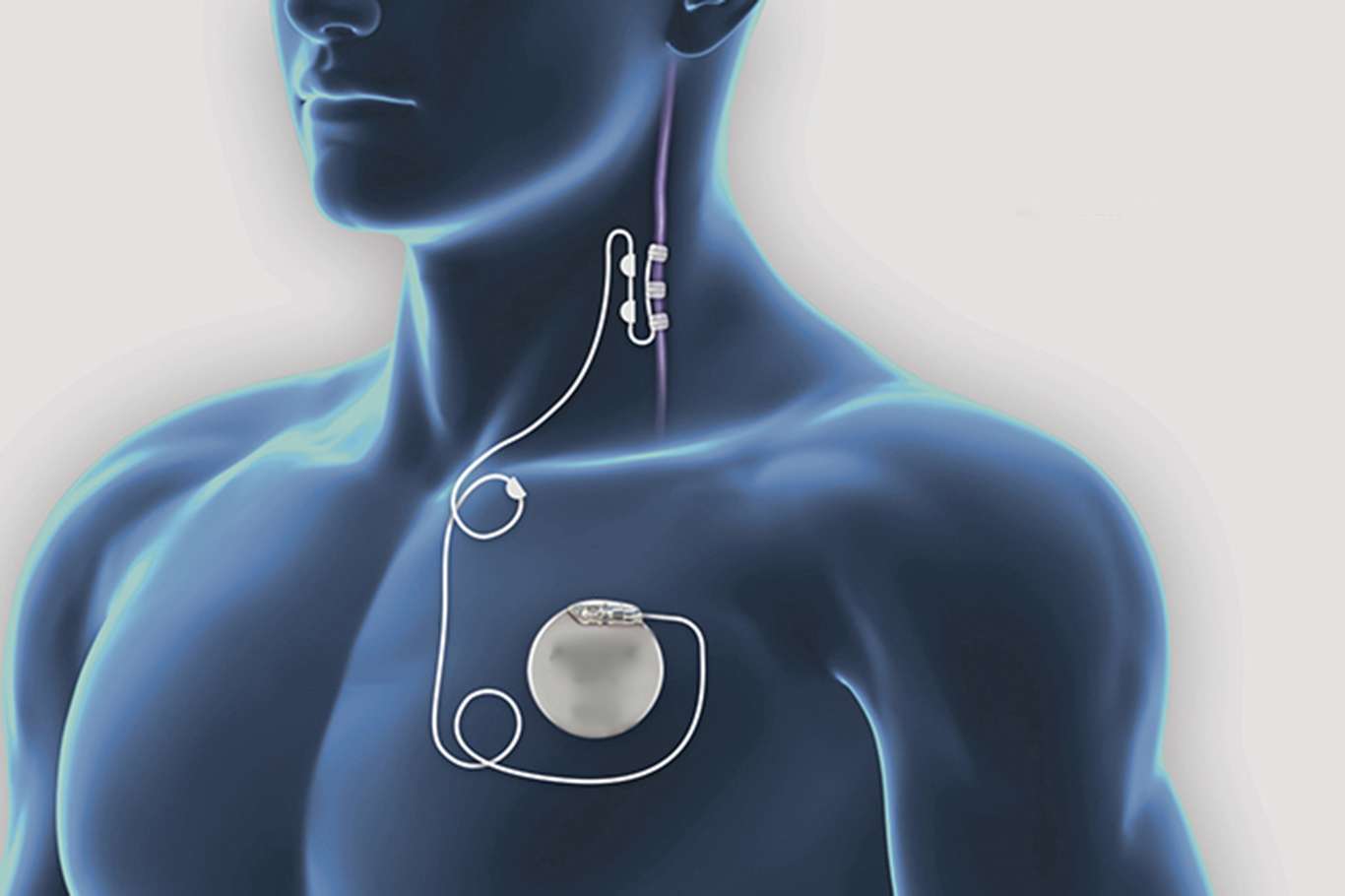 Epilepsi hastalığı ve epilepsi pili hakkında bilinmesi gerekenler